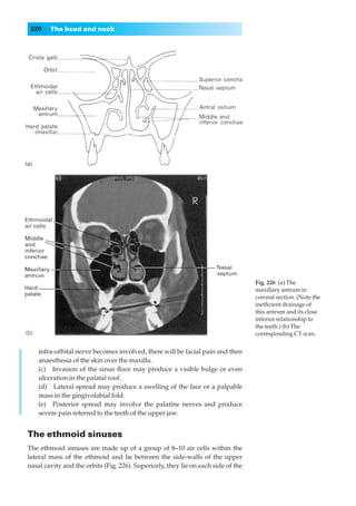 320    The head and neck




                                                                                   Fig. 226◊(a) The
                                                                                   maxillary antrum in
                                                                                   coronal section. (Note the
                                                                                   inefﬁcient drainage of
                                                                                   this antrum and its close
                                                                                   inferior relationship to
                                                                                   the teeth.) (b) The
                                                                                   corresponding CT scan.


    infra-orbital nerve becomes involved, there will be facial pain and then
    anaesthesia of the skin over the maxilla.
    (c) Invasion of the sinus ﬂoor may produce a visible bulge or even
    ulceration in the palatal roof.
    (d) Lateral spread may produce a swelling of the face or a palpable
    mass in the gingivolabial fold.
    (e) Posterior spread may involve the palatine nerves and produce
    severe pain referred to the teeth of the upper jaw.


The ethmoid sinuses
The ethmoid sinuses are made up of a group of 8–10 air cells within the
lateral mass of the ethmoid and lie between the side-walls of the upper
nasal cavity and the orbits (Fig. 226). Superiorly, they lie on each side of the
 