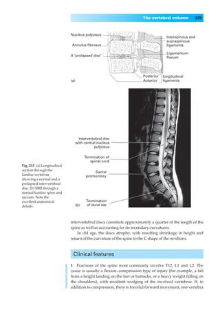 The vertebral column          329



                            Nucleus pulposus
                                                                                   Interspinous and
                                                                                   supraspinous
                            Annulus fibrosus                                       ligaments

                                                                                   Ligamentum
                            A 'prolapsed disc'                                     flavum




                                                                     Posterior   longitudinal
                            (a)                                      Anterior    ligaments




                                   Intervertebral disc
                                  with central nucleus
                                             pulposus

                                       Termination of
                                          spinal cord
Fig. 233◊(a) Longitudinal
section through the
                                            Sacral
lumbar vertebrae                        promontory
showing a normal and a
prolapsed intervertebral
disc. (b) MRI through a
normal lumbar spine and
sacrum. Note the
excellent anatomical                    Termination
details.                      (b)       of dural sac



                            intervertebral discs constitute approximately a quarter of the length of the
                            spine as well as accounting for its secondary curvatures.
                                In old age, the discs atrophy, with resulting shrinkage in height and
                            return of the curvature of the spine to the C shape of the newborn.



                             Clinical features

                            1◊◊Fractures of the spine most commonly involve T12, L1 and L2. The
                            cause is usually a ﬂexion–compression type of injury (for example, a fall
                            from a height landing on the feet or buttocks, or a heavy weight falling on
                            the shoulders), with resultant wedging of the involved vertebrae. If, in
                            addition to compression, there is forceful forward movement, one vertebra
 