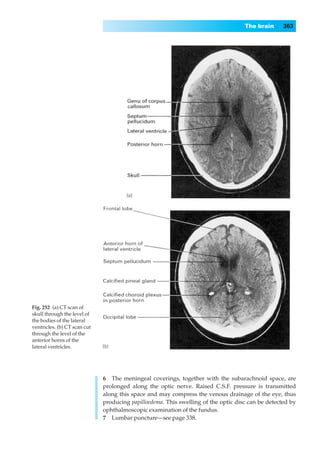 The brain      363




Fig. 252◊(a) CT scan of
skull through the level of
the bodies of the lateral
ventricles. (b) CT scan cut
through the level of the
anterior horns of the
lateral ventricles.




                              6◊◊The meningeal coverings, together with the subarachnoid space, are
                              prolonged along the optic nerve. Raised C.S.F. pressure is transmitted
                              along this space and may compress the venous drainage of the eye, thus
                              producing papilloedema. This swelling of the optic disc can be detected by
                              ophthalmoscopic examination of the fundus.
                              7◊◊Lumbar puncture—see page 338.
 
