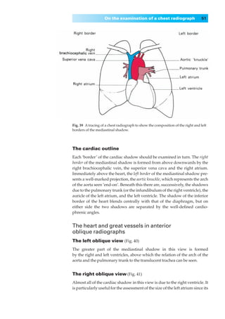 On the examination of a chest radiograph                      51




Fig. 39◊A tracing of a chest radiograph to show the composition of the right and left
borders of the mediastinal shadow.




The cardiac outline
Each ‘border’ of the cardiac shadow should be examined in turn. The right
border of the mediastinal shadow is formed from above downwards by the
right brachiocephalic vein, the superior vena cava and the right atrium.
Immediately above the heart, the left border of the mediastinal shadow pre-
sents a well-marked projection, the aortic knuckle, which represents the arch
of the aorta seen ‘end-on’. Beneath this there are, successively, the shadows
due to the pulmonary trunk (or the infundibulum of the right ventricle), the
auricle of the left atrium, and the left ventricle. The shadow of the inferior
border of the heart blends centrally with that of the diaphragm, but on
either side the two shadows are separated by the well-deﬁned cardio-
phrenic angles.


The heart and great vessels in anterior
oblique radiographs
The left oblique view (Fig. 40)
The greater part of the mediastinal shadow in this view is formed
by the right and left ventricles, above which the relation of the arch of the
aorta and the pulmonary trunk to the translucent trachea can be seen.


The right oblique view (Fig. 41)
Almost all of the cardiac shadow in this view is due to the right ventricle. It
is particularly useful for the assessment of the size of the left atrium since its
 