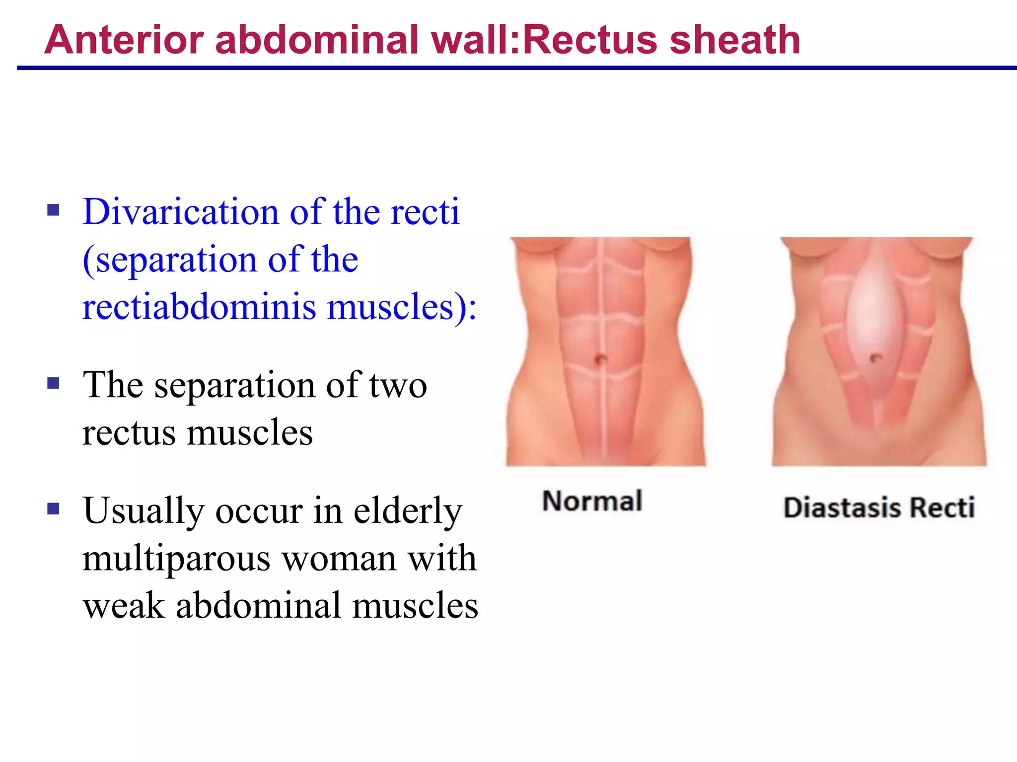 Rectus Devirication Clinical anatomy of abdominal wall and pelvic wall | PPT
