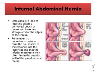 Internal Abdominal Hernia
• Occasionally, a loop of
intestine enters a
peritoneal pouch or
recess and becomes
strangulated at the edges
of the recess.
• Remember that
important structures
form the boundaries of
the entrance into the
lesser sac and that the
inferior mesenteric vein
often lies in the anterior
wall of the paraduodenal
recess.
 