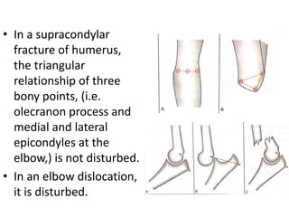 • In a supracondylar
fracture of humerus,
the triangular
relationship of three
bony points, (i.e.
olecranon process and
medial and lateral
epicondyles at the
elbow,) is not disturbed.
• In an elbow dislocation,
it is disturbed.
 