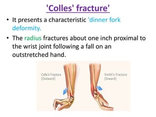 'Colles' fracture'
• It presents a characteristic 'dinner fork
deformity.
• The radius fractures about one inch proximal to
the wrist joint following a fall on an
outstretched hand.
 