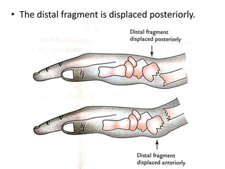 • The distal fragment is displaced posteriorly.
 
