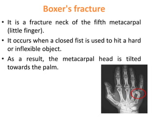 Boxer's fracture
• It is a fracture neck of the fifth metacarpal
(little finger).
• It occurs when a closed fist is used to hit a hard
or inflexible object.
• As a result, the metacarpal head is tilted
towards the palm.
 