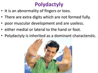Polydactyly
• It is an abnormality of fingers or toes.
• There are extra digits which are not formed fully.
• poor muscular development and are useless.
• either medial or lateral to the hand or foot.
• Polydactyly is inherited as a dominant characterstic.
 