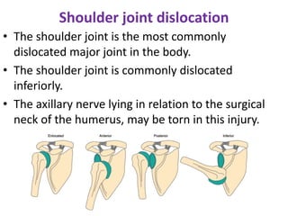 Shoulder joint dislocation
• The shoulder joint is the most commonly
dislocated major joint in the body.
• The shoulder joint is commonly dislocated
inferiorly.
• The axillary nerve lying in relation to the surgical
neck of the humerus, may be torn in this injury.
 