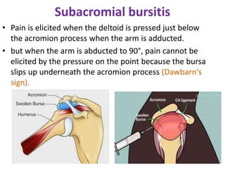 Subacromial bursitis
• Pain is elicited when the deltoid is pressed just below
the acromion process when the arm is adducted.
• but when the arm is abducted to 90°, pain cannot be
elicited by the pressure on the point because the bursa
slips up underneath the acromion process (Dawbarn's
sign).
 