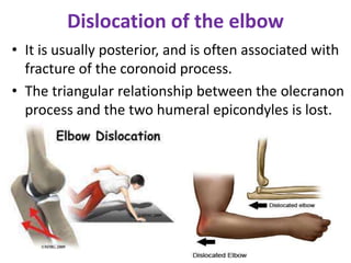Dislocation of the elbow
• It is usually posterior, and is often associated with
fracture of the coronoid process.
• The triangular relationship between the olecranon
process and the two humeral epicondyles is lost.
 