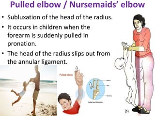 Pulled elbow / Nursemaids’ elbow
• Subluxation of the head of the radius.
• It occurs in children when the
forearm is suddenly pulled in
pronation.
• The head of the radius slips out from
the annular ligament.
 