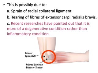 • This is possibly due to:
a. Sprain of radial collateral ligament.
b. Tearing of fibres of extensor carpi radialis brevis.
c. Recent researches have pointed out that it is
more of a degenerative condition rather than
inflammatory condition.
 