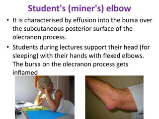 Student's (miner's) elbow
• It is characterised by effusion into the bursa over
the subcutaneous posterior surface of the
olecranon process.
• Students during lectures support their head (for
sleeping) with their hands with flexed elbows.
The bursa on the olecranon process gets
inflamed
 