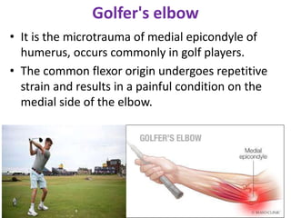 Golfer's elbow
• It is the microtrauma of medial epicondyle of
humerus, occurs commonly in golf players.
• The common flexor origin undergoes repetitive
strain and results in a painful condition on the
medial side of the elbow.
 