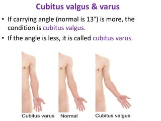 Cubitus valgus & varus
• If carrying angle (normal is 13°) is more, the
condition is cubitus valgus.
• If the angle is less, it is called cubitus varus.
 