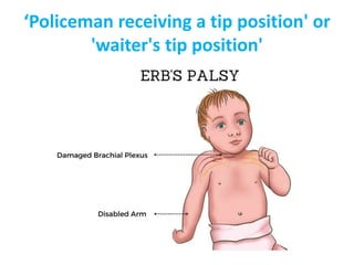 ‘Policeman receiving a tip position' or
'waiter's tip position'
 