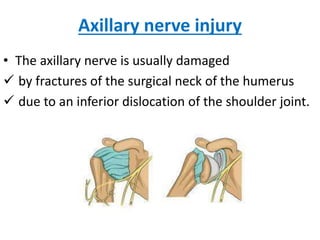 Axillary nerve injury
• The axillary nerve is usually damaged
 by fractures of the surgical neck of the humerus
 due to an inferior dislocation of the shoulder joint.
 