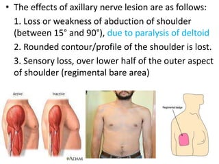 • The effects of axillary nerve lesion are as follows:
1. Loss or weakness of abduction of shoulder
(between 15° and 90°), due to paralysis of deltoid
2. Rounded contour/profile of the shoulder is lost.
3. Sensory loss, over lower half of the outer aspect
of shoulder (regimental bare area)
 