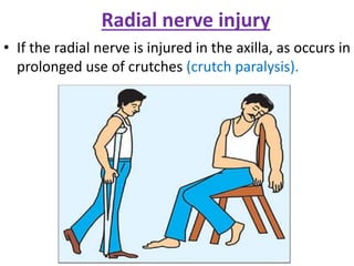 Radial nerve injury
• If the radial nerve is injured in the axilla, as occurs in
prolonged use of crutches (crutch paralysis).
 