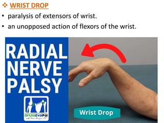  WRIST DROP
• paralysis of extensors of wrist.
• an unopposed action of flexors of the wrist.
 