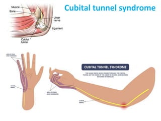 Cubital tunnel syndrome
 