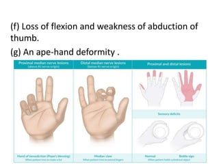 (f) Loss of flexion and weakness of abduction of
thumb.
(g) An ape-hand deformity .
 