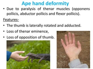 Ape hand deformity
• Due to paralysis of thenar muscles (opponens
pollicis, abductor pollicis and flexor pollicis).
Features-
• The thumb is laterally rotated and adducted.
• Loss of thenar eminence,
• Loss of opposition of thumb.
 