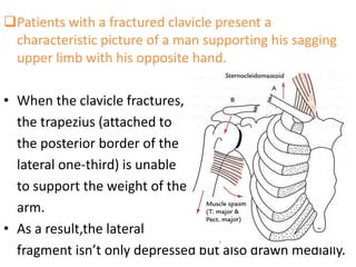Patients with a fractured clavicle present a
characteristic picture of a man supporting his sagging
upper limb with his opposite hand.
• When the clavicle fractures,
the trapezius (attached to
the posterior border of the
lateral one-third) is unable
to support the weight of the
arm.
• As a result,the lateral
fragment isn’t only depressed but also drawn medially.
 