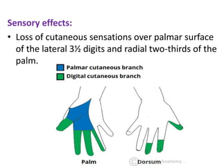 Sensory effects:
• Loss of cutaneous sensations over palmar surface
of the lateral 3½ digits and radial two-thirds of the
palm.
 