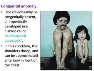 Congenital anomaly
• The clavicles may be
congenitally absent,
or imperfectly
developed in a
disease called
“cleidocranial
dysostosis”.
• In this condition, the
shoulders droop, and
can be approximated
anteriorly in front of
the chest.
 