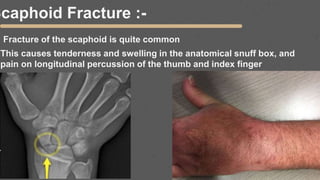 Scaphoid Fracture :-
Fracture of the scaphoid is quite common
This causes tenderness and swelling in the anatomical snuff box, and
pain on longitudinal percussion of the thumb and index finger
 