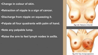 •Change in colour of skin.
•Retraction of nipple is a sign of cancer.
•Discharge from nipple on squeezing it.
•Palpate all four quadrants with palm of hand.
•Note any palpable lump.
•Raise the arm to feel lymph nodes in axilla.
 