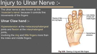 Injury to Ulnar Nerve :-
The ulnar nerve is also known as the
‘musician’s nerve’ because it controls fine
movements of the fingers
Ulnar Claw hand :-
Hyperextension at the metacarpophalangeal
joints and flexion at the interphalangeal
joints,
involving the ring and little fingers more than
the index and middle fingers
 