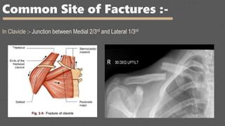 Common Site of Factures :-
In Clavicle :- Junction between Medial 2/3rd and Lateral 1/3rd
 