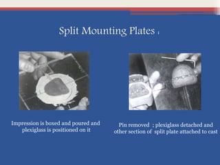 Split Mounting Plates :
Pin removed ; plexiglass detached and
other section of split plate attached to cast
Impression is boxed and poured and
plexiglass is positioned on it
 