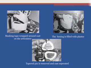 Masking tape wrapped around cast
on the articulator
The boxing is filled with plaster
Tapered pin is removed and cast seperated
 