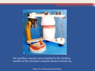 The maxillary remount cast is attached to the maxillary
member of the articulator using the facebow transfer jig
Steps for clinical remounting
 