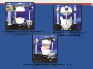 Customized mounting platforms secured
on articulator
Remount casts obtained in putty
impression material.
Mounting done with centric interocclusal record.
 