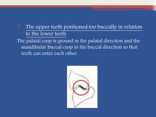 3. The upper teeth positioned too buccally in relation
to the lower teeth
The palatal cusp is ground in the palatal direction and the
mandibular buccal cusp in the buccal direction so that
teeth can enter each other.
 