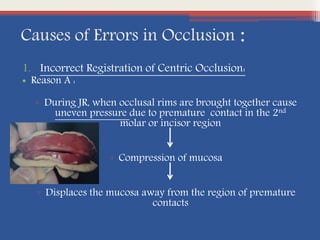 Causes of Errors in Occlusion :
1. Incorrect Registration of Centric Occlusion:
• Reason A :
▫ During JR, when occlusal rims are brought together cause
uneven pressure due to premature contact in the 2nd
molar or incisor region
▫ Compression of mucosa
▫ Displaces the mucosa away from the region of premature
contacts
 