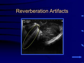 Tomb Reverberation Clinical Applications of Chest Sonography | PDF