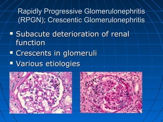 Crescentic Rpgn Clinical Applications Of Therapeutic Apheresis | PPT