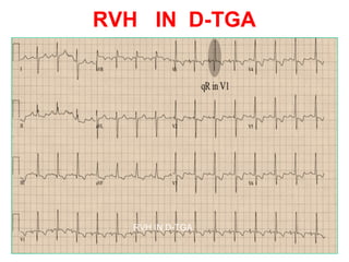 Tga Rch Clinical approach to congenital heart disease diagnosis | PPT