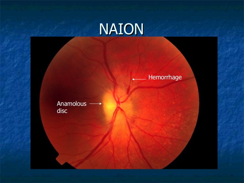 Clinical approach to optic neuritis