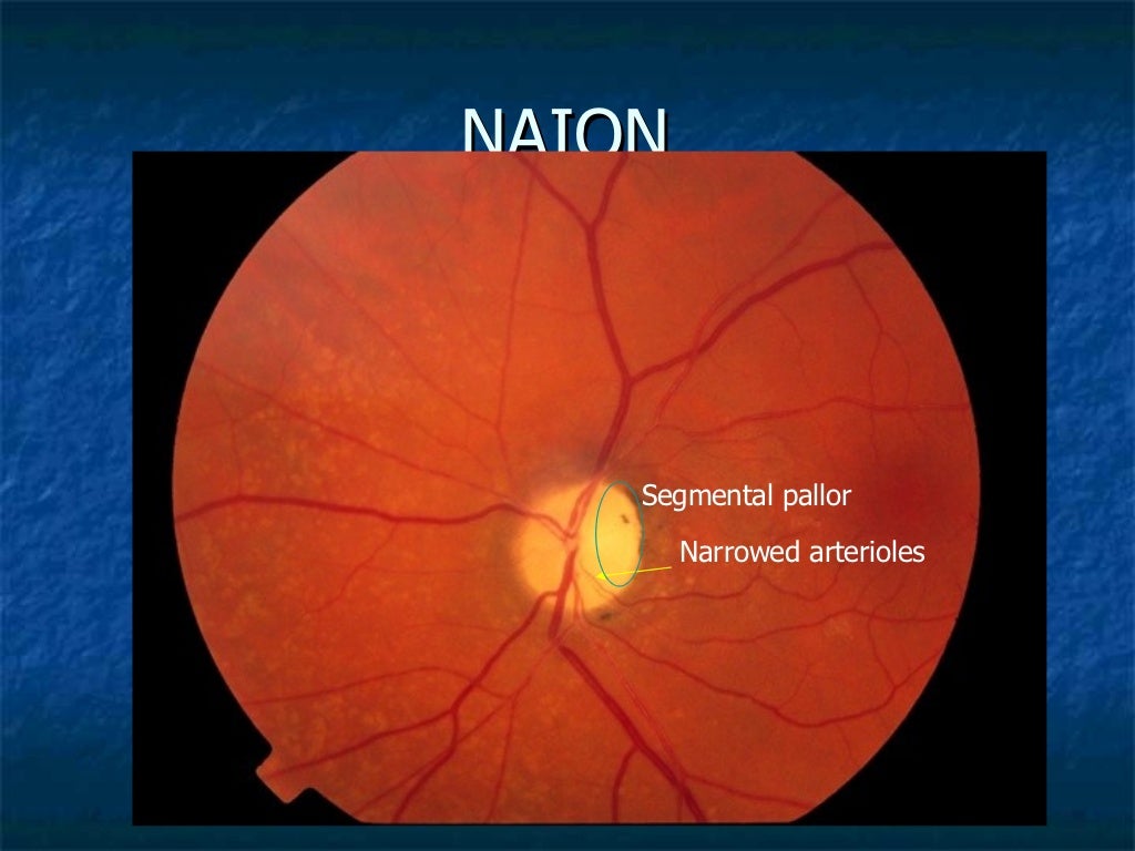 Clinical approach to optic neuritis
