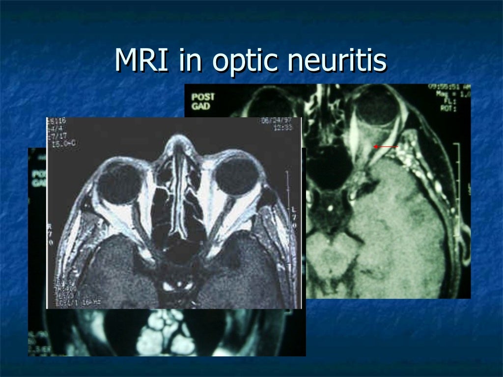 Clinical approach to optic neuritis