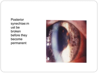 Posterior
synechiae:m
ust be
broken
before they
become
permanent
 