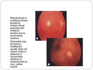Retinitis:focal or
multifocal.charac
terised by
whitish retinal
opacities with
indistinct
borders due to
surrounding
oedema.
Choroiditis:may
be focal or
multifocal.it
usually does not
induce vitritis in
absence of
concomitant
retinitis.it is
characterized by
roun .yellow
nodule
 