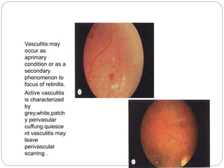 Vasculitis:may
occur as
aprimary
condition or as a
secondary
phenomenon to
focus of retinitis.
Active vasculitis
is characterized
by
grey,white,patch
y perivasular
cuffung.quiesce
nt vasculitis may
leave
perivascular
scarring .
 
