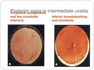 Posterior signs in intermediate uveitisPeripheral periphlebitis
and few snowballs
inferiorly
Inferior snowbabanking
and snowballs
 